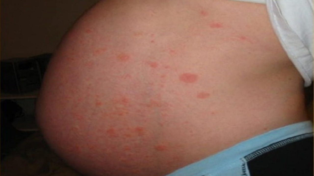 Colestasis En El Embarazo Beliefnet